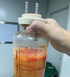 朝阳水动力吸脂手术要做多久？